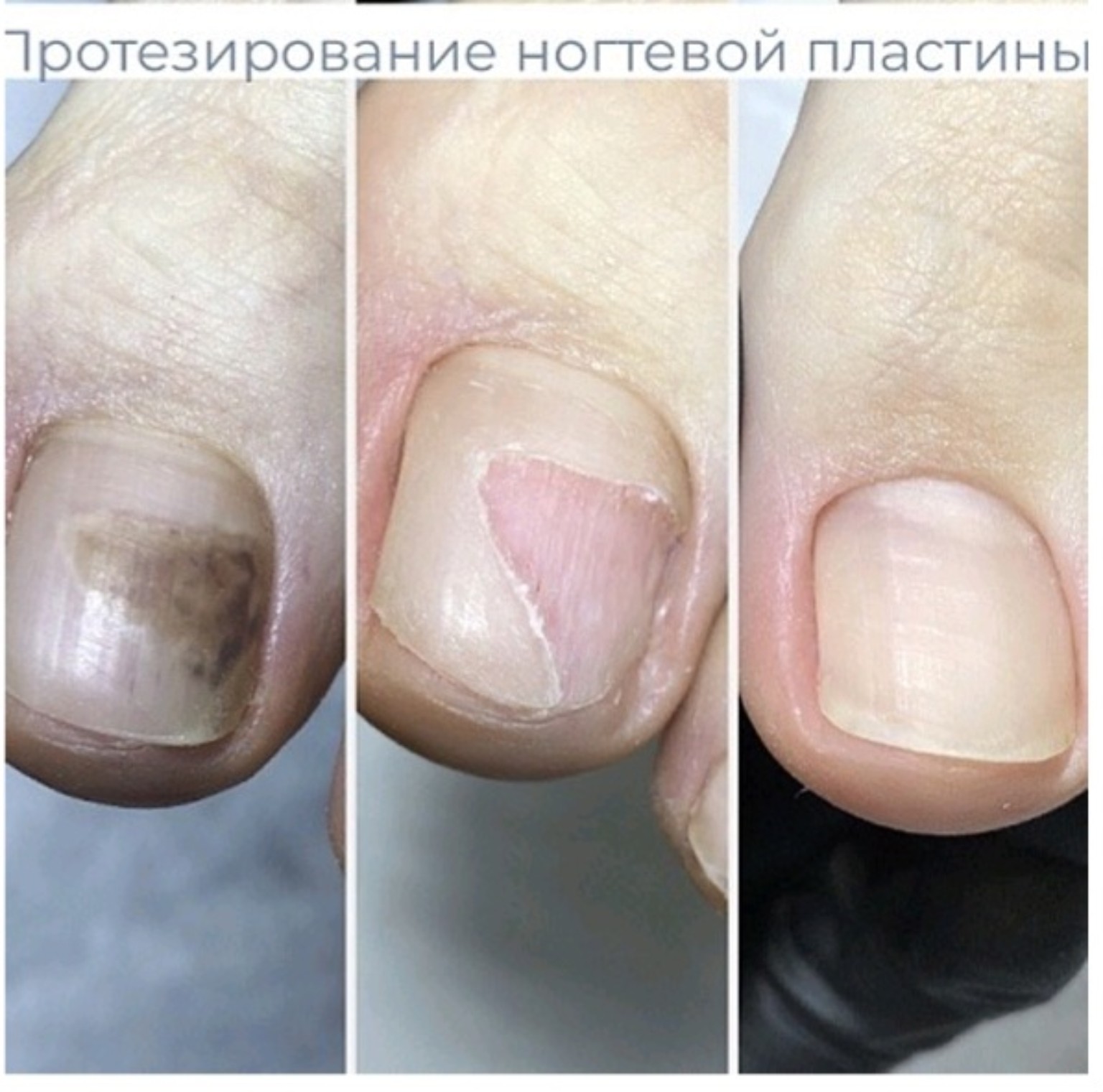 Восстановление ногтевой пластины — этапы до и после