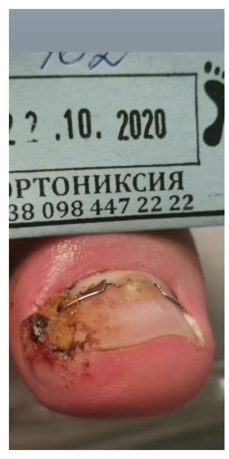 Скоба 3TO Omega — до коррекции вросшего ногтя