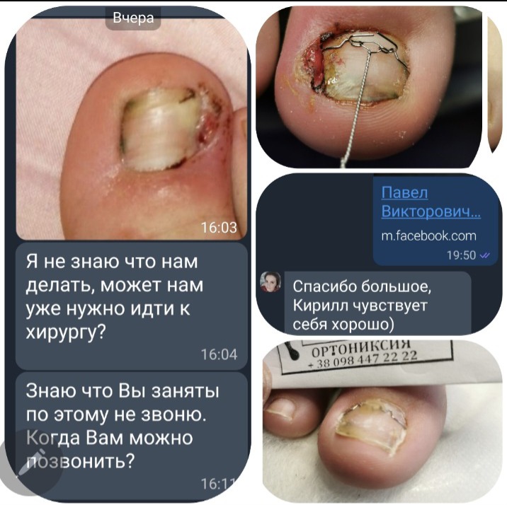 Переписка с пациентом и фотографии безоперационной коррекции вросшего ногтя