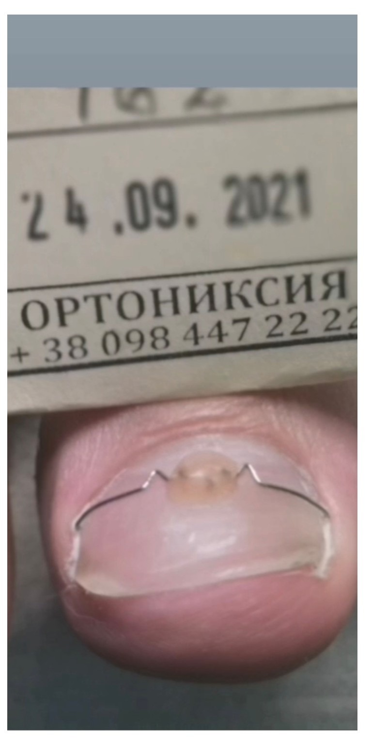 Скоба 3TO Omega