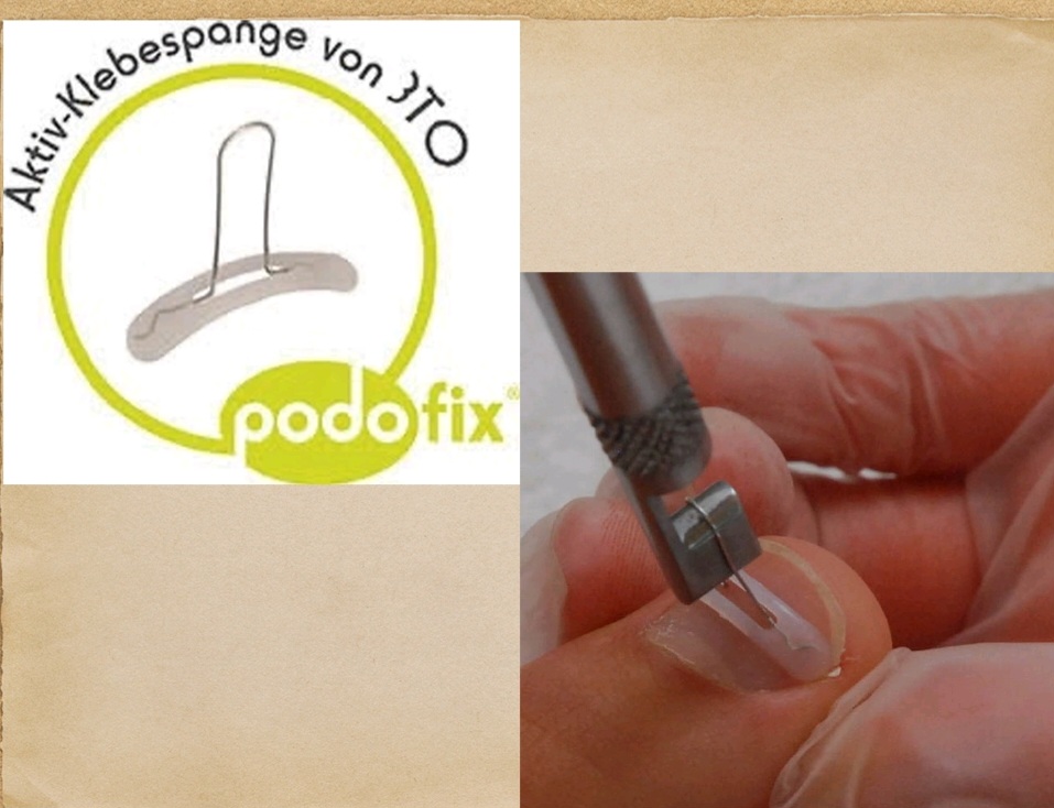 Что такое Podofix?